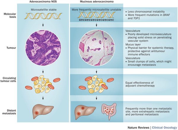 Отличительные особенности муцинозного рака от аденокарциномы